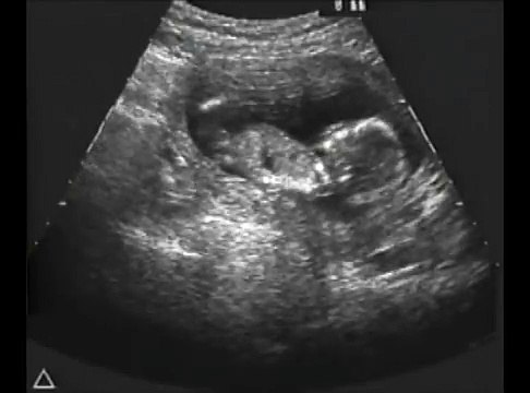 Ultrasound Fetal Response To Alcohol Fetal Alcohol Syndrome