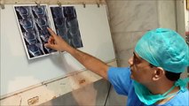 Bone Marrow Stem Cell Treatment Knee Osteoarthritis India - Dr.A.K.Venkatachalam