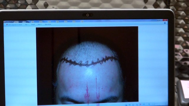Bald Hair Loss Man Hairline Transplant Surgery 12 Months Follow Up Result Dr. Diep mhtaclinic.com