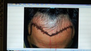 Excellent Man Hairline Bald Hair Loss Transplant Restoration Surgery 1 Yr Result Dr. Diep www.mhtaclinic.com