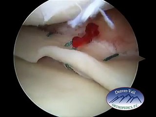 Meniscus Tear and Repair with Sutures
