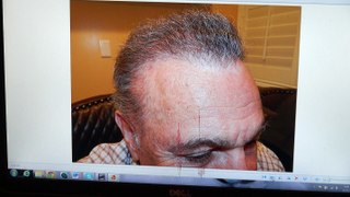 Fantastic Male Hairline Restoration Transplant Surgery Dr. Diep www.mhtaclinic.com 1 Year Follow Up Before After Photos