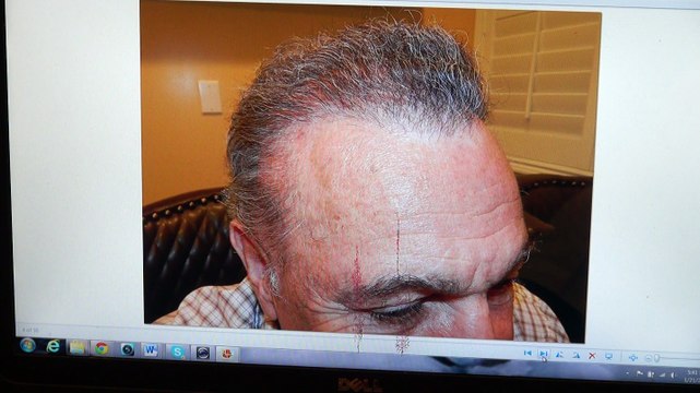 Fantastic Male Hairline Restoration Transplant Surgery Dr. Diep mhtaclinic.com 1 Year Follow Up Before After Photos