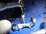 Endodoncia Rotacional - Protaper - CLINICA DENTAL KREBS - LIMA PERU