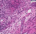 Histopathology Cervix- - Squamous cell carcinoma
