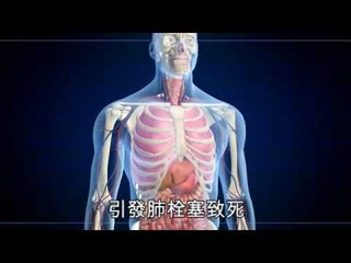 NMA 2009.12.18 動新聞 靜脈曲張 泡湯捉癢血染池水