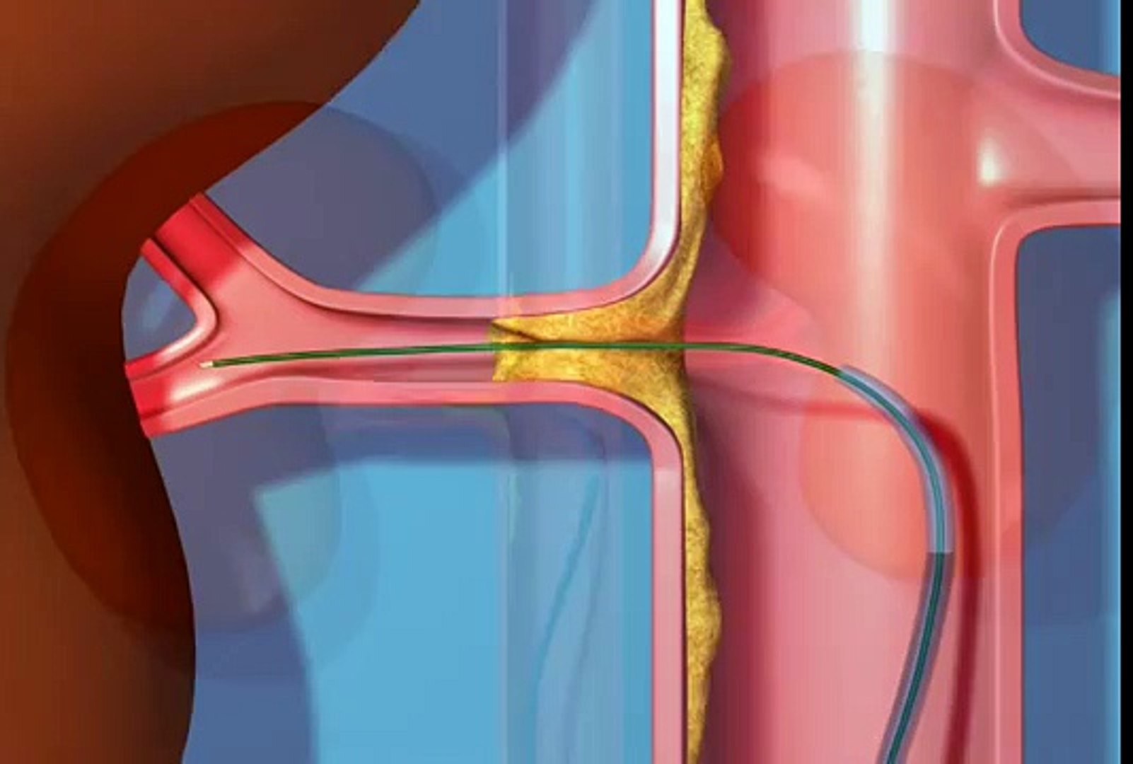 ⁣Renal Stent Procedure Animation