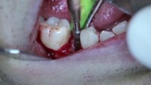 Une Dent 'ouvre-bouteille' implantée dans la bouche!