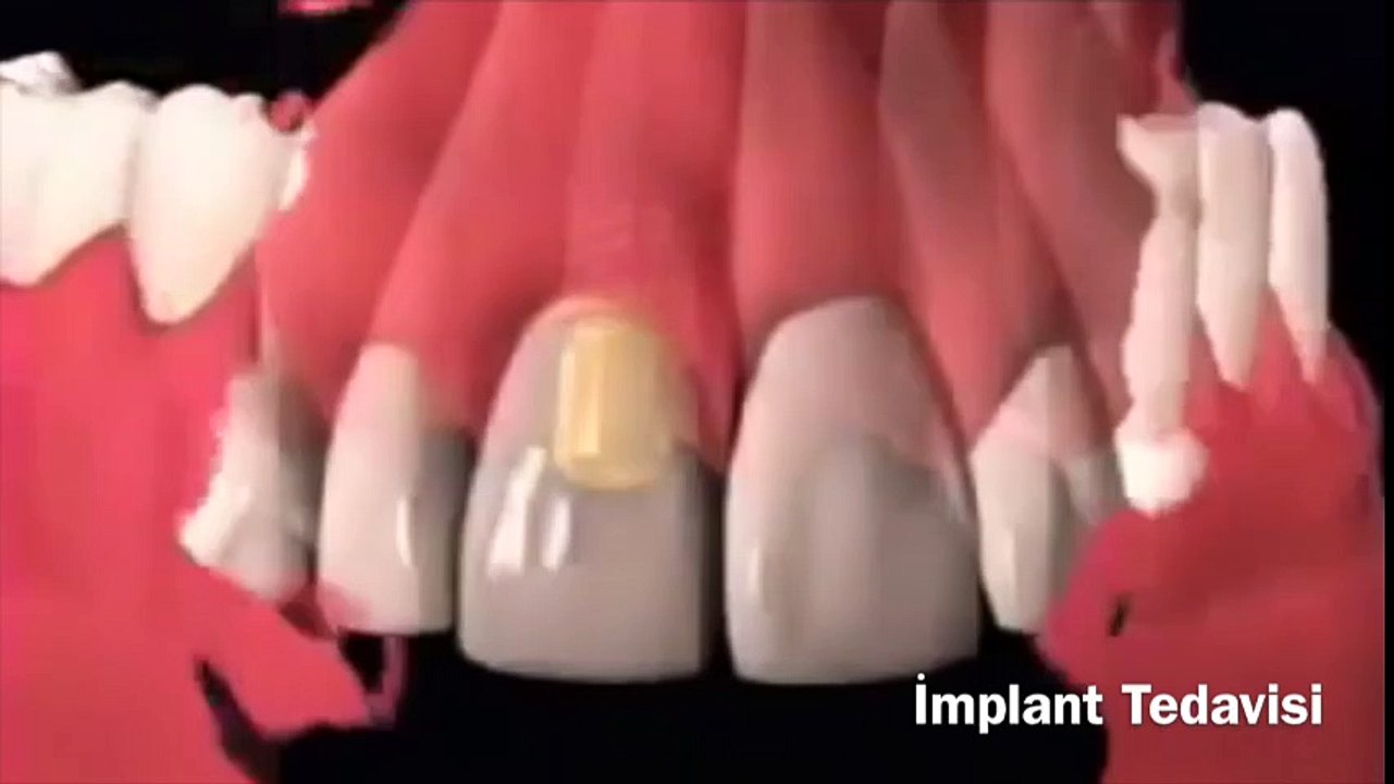 implant
