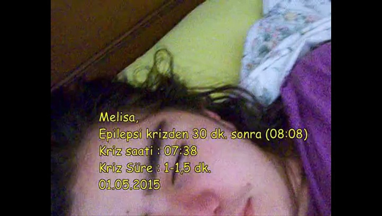 01.05.2015 - Epilepsi Krizi