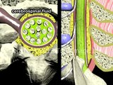 Epidural Spinal Anesthesia - Animation by Cal Shipley, M.D.