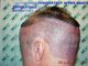 FUE Hair Transplant Result - 3050 Grafts - HDC Hair Transplant Clinic