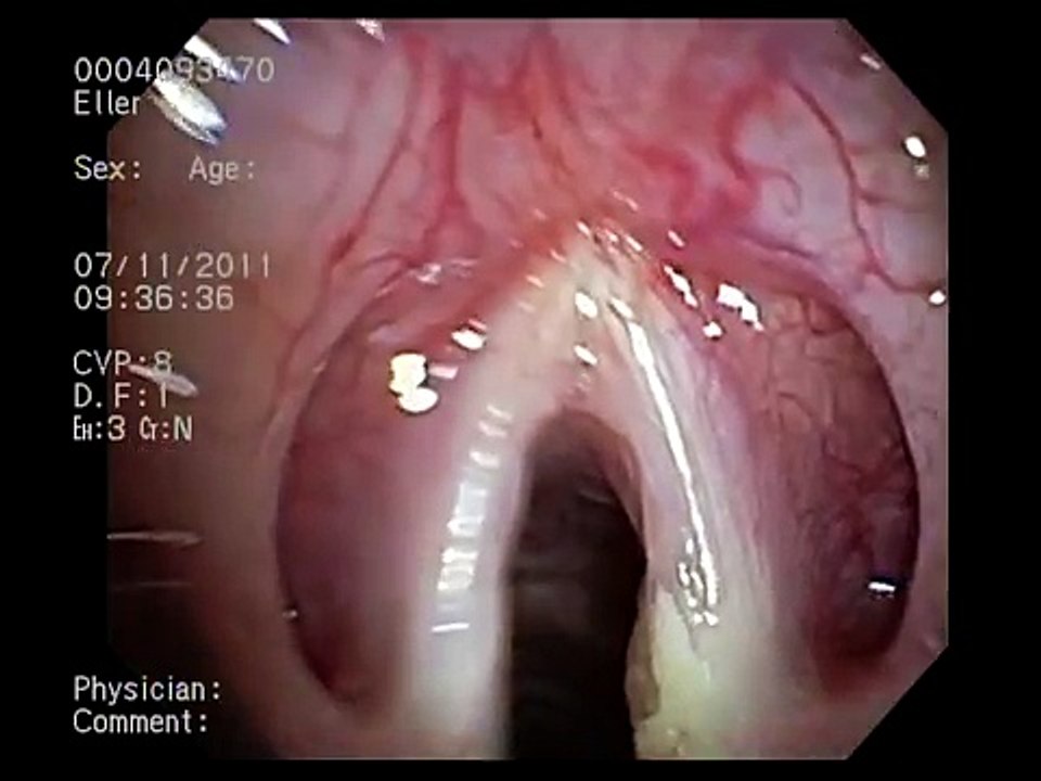 My Bronchoscopy
