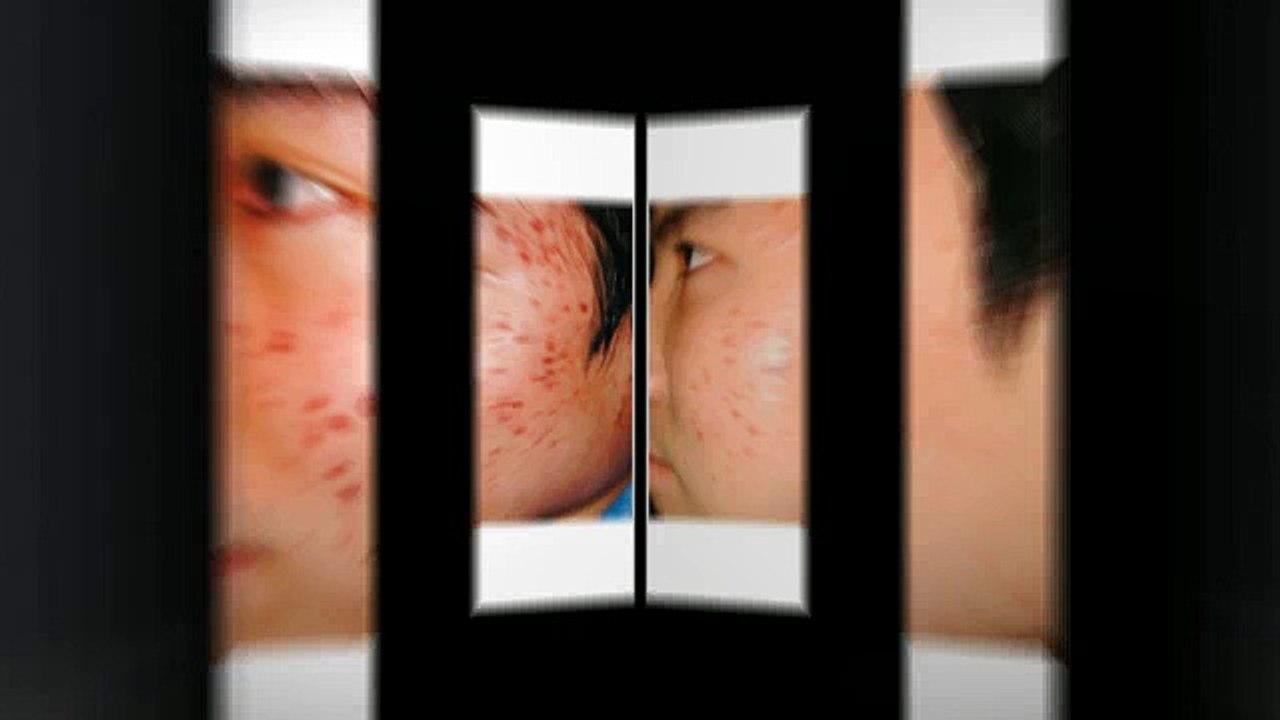 ANTI SCAR CREAM