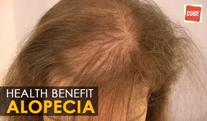 Alopecia Areata - Home Remedies | Health Tips