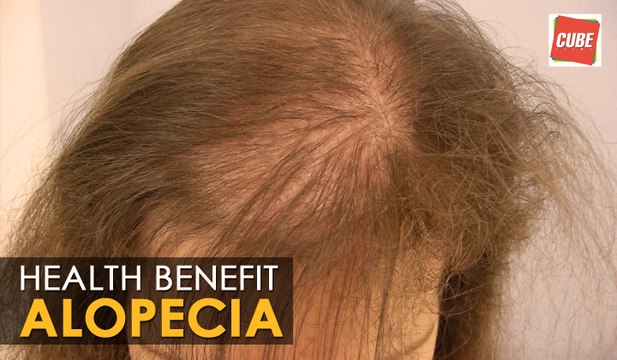 Alopecia Areata - Home Remedies | Health Tips
