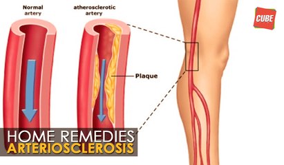 Arteriosclerosis Treatment - Home Remedies | Health Tips