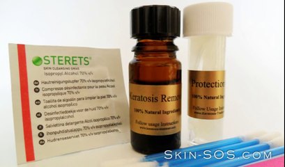 Keratosis Treatment - How To Remove Keratosis @ Home