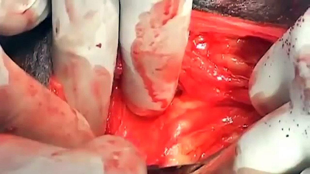 bladder stone removal