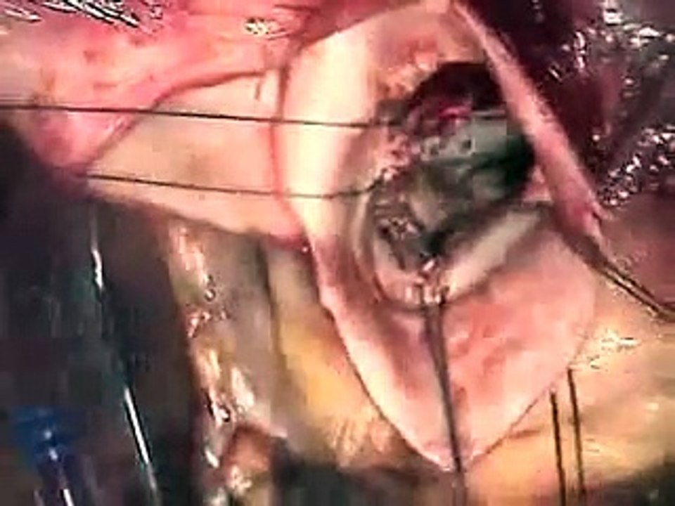 Aortic Valve Replacement