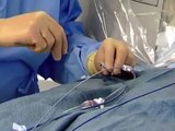 Cardiac Arrhythmia Ablation Surgery Video - Brigham and Women's Hospital