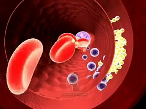 Myocardial Infarction