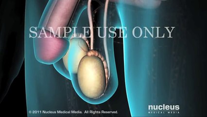 Low Testosterone (Low T)