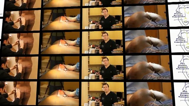 AUTOLOGUS BUTTOCK AUGMENTATION WITH A SPLIT GLUTEUS MAXIMUS MYOCUTANEUS FLAP by Ozan SOZER