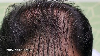 CLINICAS CETA CAPITAL www.injertodepelo.es