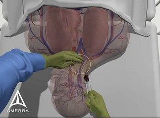 Central Line Procedure - 3D Medical Animation