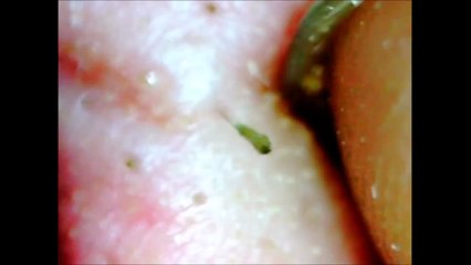 25 Year old Blackhead gets popped right at the camera