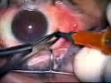 vitrectomia vitrectomy cirurgia olho mosca volantes floaters