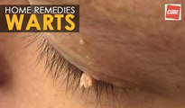 Warts Removal - Home Remedies | Health Tips