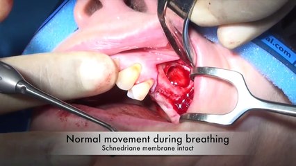 Maxillary Sinus lift Lateral Window. Kuljeet MEHTA-Periodontist. www:kmperio.co.uk