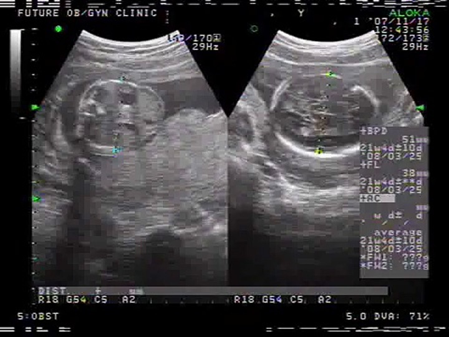 5 Month Ultrasound Video Dailymotion