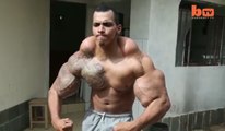 Muscle Injections Almost Cost This Man His Arms