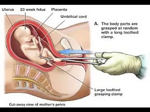 Dilation And Evacuation Abortion Illustrated / Pro-Life Anti-Abortion Video