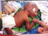 Conjoined Twins Separated in Womb