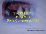 Sinus lift video :using MIS-Implants Bone compression kit