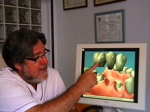 prótesis fija sobre dientes naturales