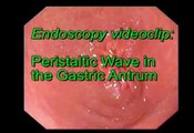 Peristaltic Wave in the Gastric Antrum