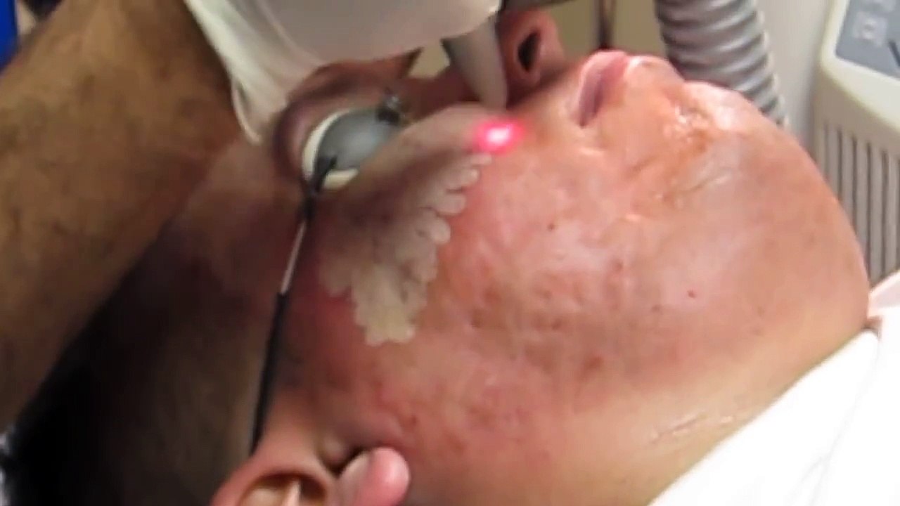 Acne Scar Removal-Deep Erbium Laser Peel-Pasadena-Burbank-Los Angeles-Glendale-Beverly Hills-Arcadia