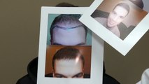 Excellent Male Hairline Hair Loss Transplant Restoration Surgery Dr. Diep www.mhtaclinic.com Before After Photos