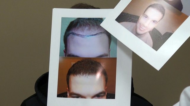 Excellent Male Hairline Hair Loss Transplant Restoration Surgery Dr. Diep mhtaclinic.com Before After Photos