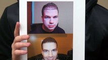Men Hair Loss Transplant Treatment Before After Photos Dr. Diep www.mhtaclinic.com