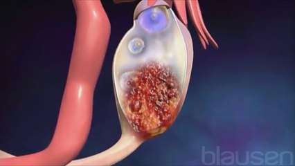 طريقة جديدة دقيقة للكشف عن سرطان المبيض