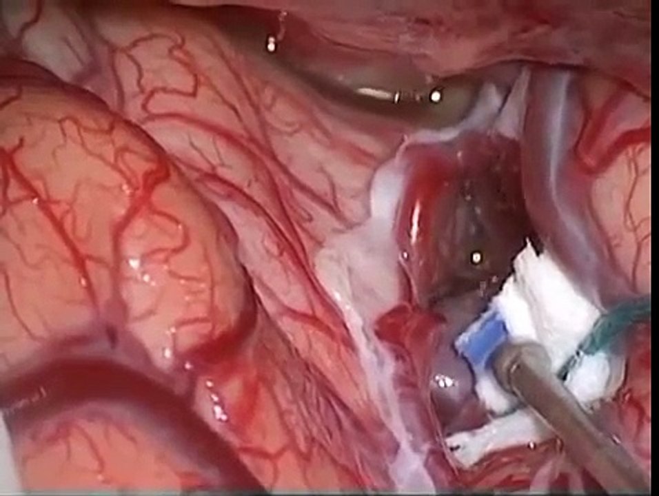 brain aneurysm surgery