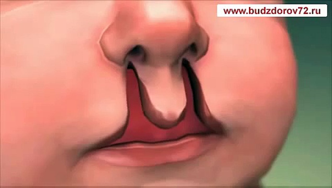 Medical Animation. Cleft lip and palate