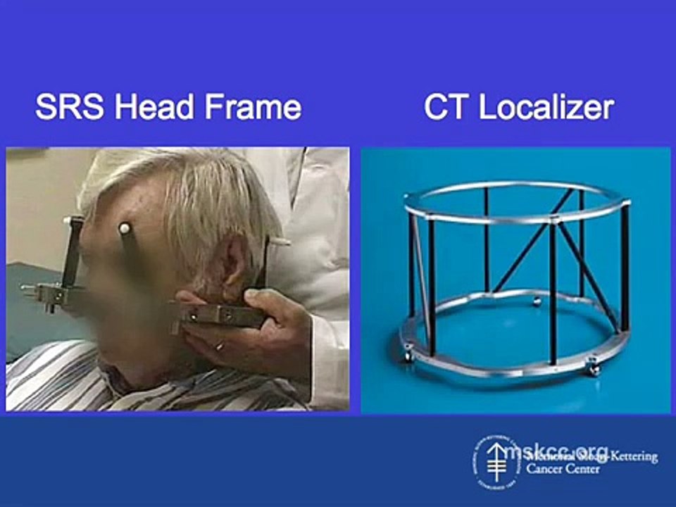 Brain Tumor Radiation Therapy | IMRT, IGRT, SRS| Memorial Sloan Kettering