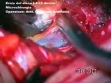 Ernia del disco lombare. Trattamento microchirurgico